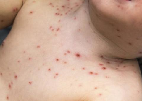 30 casos de sarampo são confirmados em Manaus; Veja as zonas mais atingidas