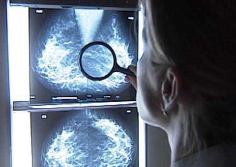 Cientistas descobrem composto capaz de bloquear metástases de cânceres  