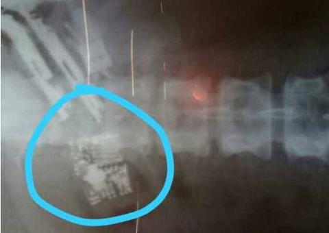 Detento engole cinco celulares e fica em estado grave ao não conseguir expelir aparelhos