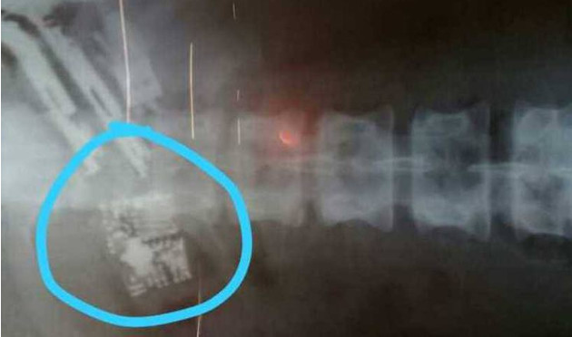 Detento engole cinco celulares e fica em estado grave ao não conseguir expelir aparelhos