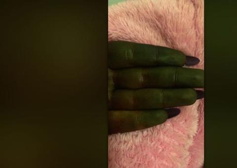 Mulher fica com pele 'bizarra' após usar autobronzeador