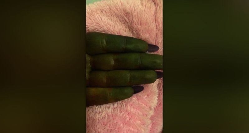 Mulher fica com pele 'bizarra' após usar autobronzeador