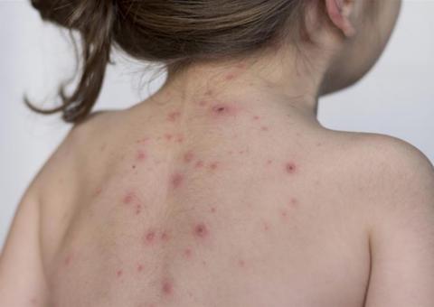 Sobe para 493 casos suspeitos de sarampo em Manaus, diz Semsa