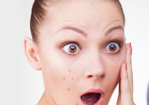 Sabia que celular pode piorar sua acne? Veja como evitar que isso aconteça