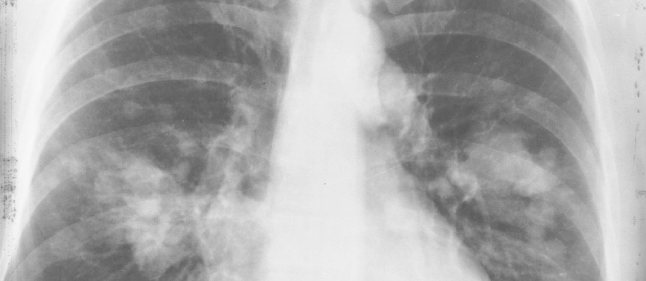 Imunoterapia é opção contra câncer de pulmão