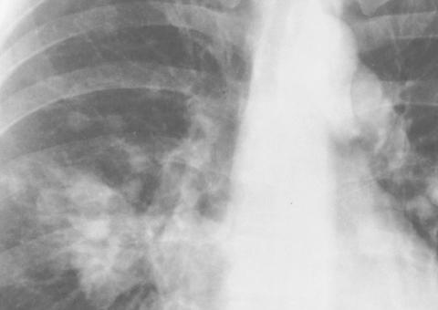 Imunoterapia é opção contra câncer de pulmão