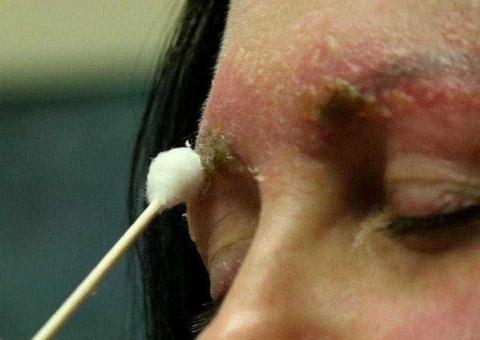 Mulher quase morre ao pegar infecção na sobrancelha após microblading