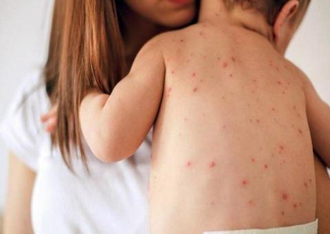 Aumenta para 263 o número de casos de sarampo confirmados em Manaus