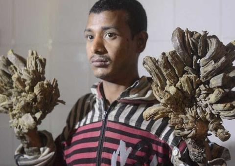 Homem árvore abandona tratamento e segue com rara síndrome