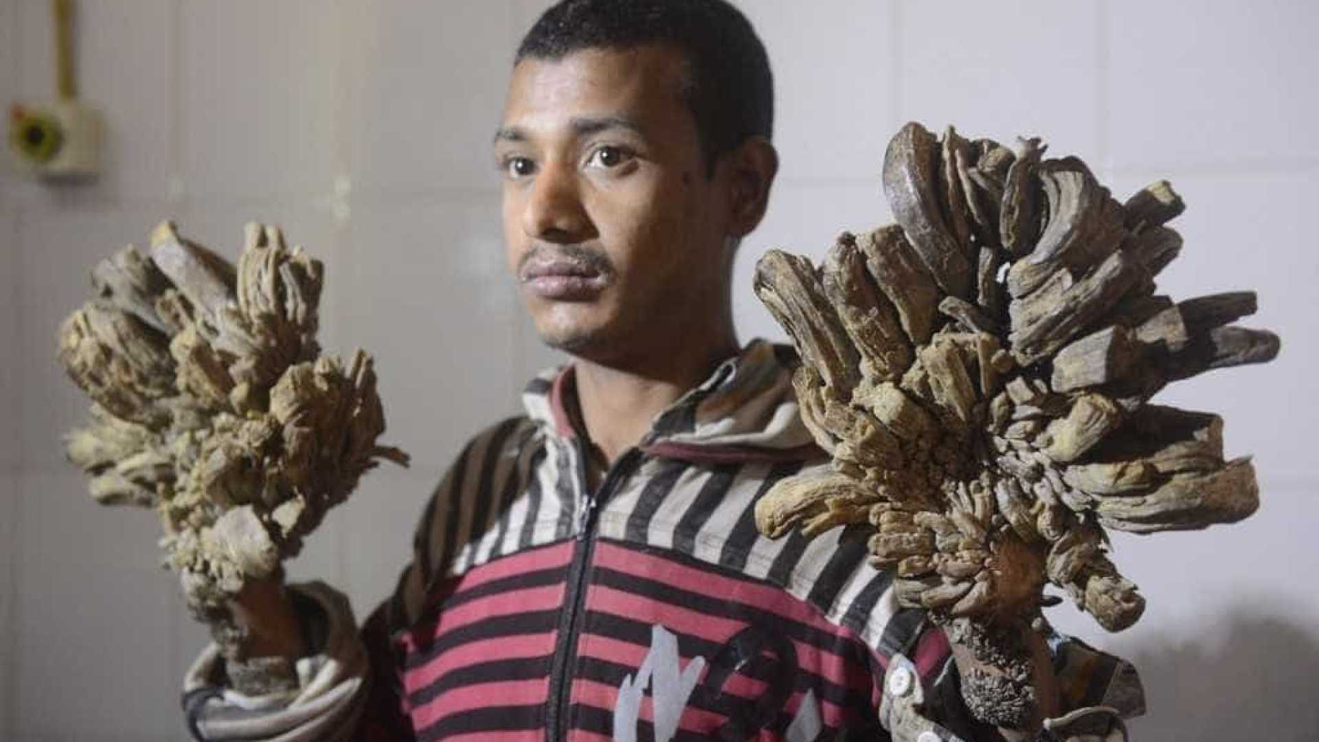 Homem árvore abandona tratamento e segue com rara síndrome