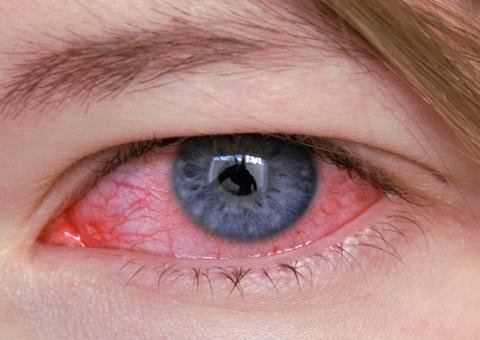 Ficar coçando os olhos pode causar problemas de vista graves