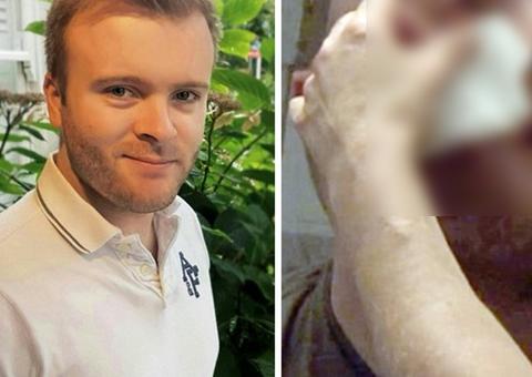 Professor dorme com lentes de contato e desenvolve úlcera nos olhos