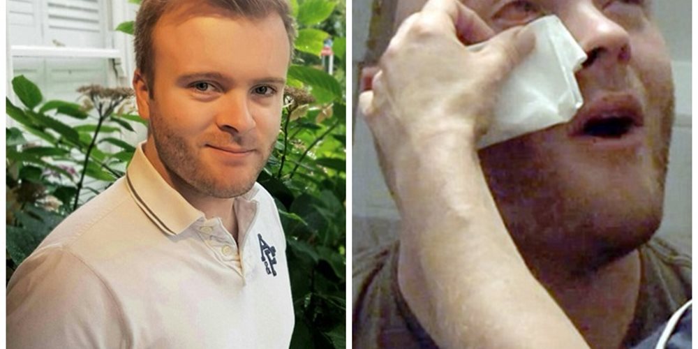 Professor dorme com lentes de contato e desenvolve úlcera nos olhos