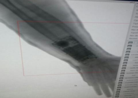 Jovem é preso com celular escondido em gesso durante prova de concurso