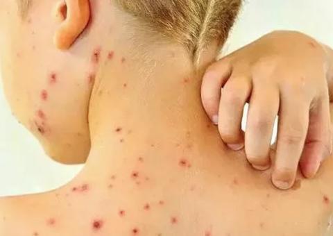 Manaus decreta situação de emergência diante de surto de sarampo 