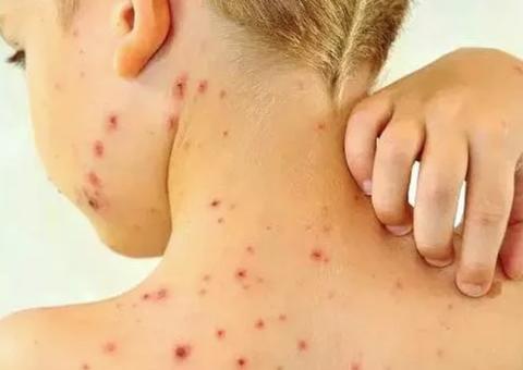 Primeira morte por Sarampo é confirmada em Manaus