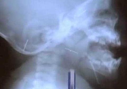 Para afastar 'espíritos ruins', babá enfia dez agulhas em corpo de bebê