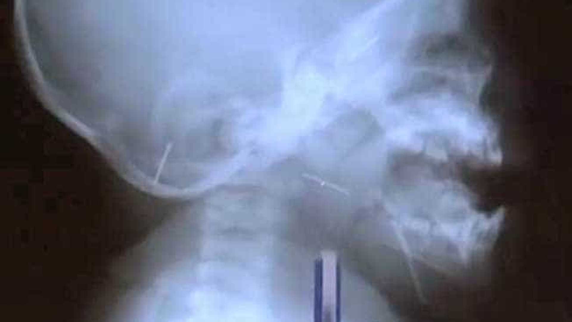 Para afastar 'espíritos ruins', babá enfia dez agulhas em corpo de bebê