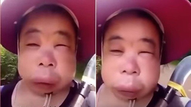 Mulher fica com rosto deformado ao tentar tirar mel de colmeia