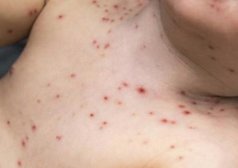 Doenças erradicadas criam falsa sensação de que vacina é desnecessária