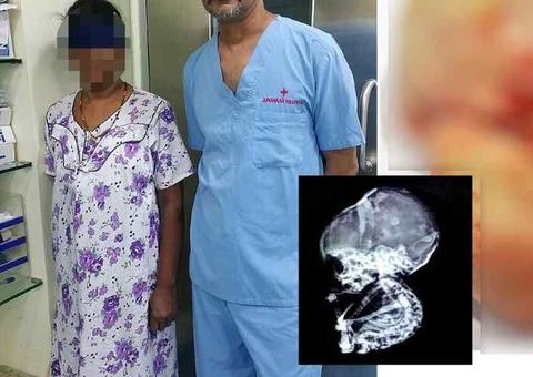 Mulher descobre 'bebê de pedra' em barriga após ter acreditado em aborto
