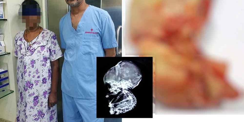 Mulher descobre 'bebê de pedra' em barriga após ter acreditado em aborto