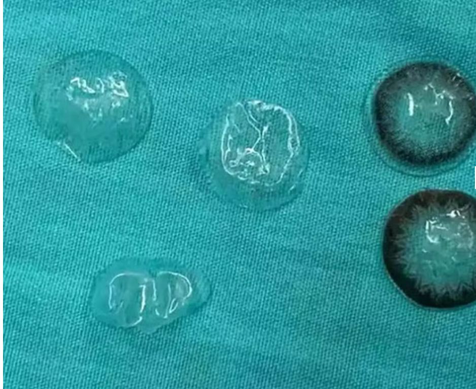 Mulher descobre cinco lentes de contato no olho após cirurgia