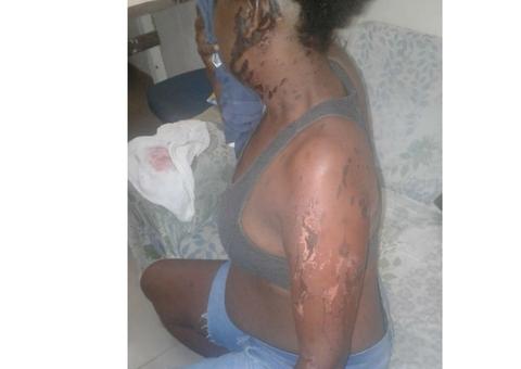 Mulher é atacada com ácido por ex após fim de namoro