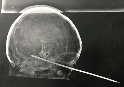 Menino tem espeto cravado no olho durante brincadeira com amigo