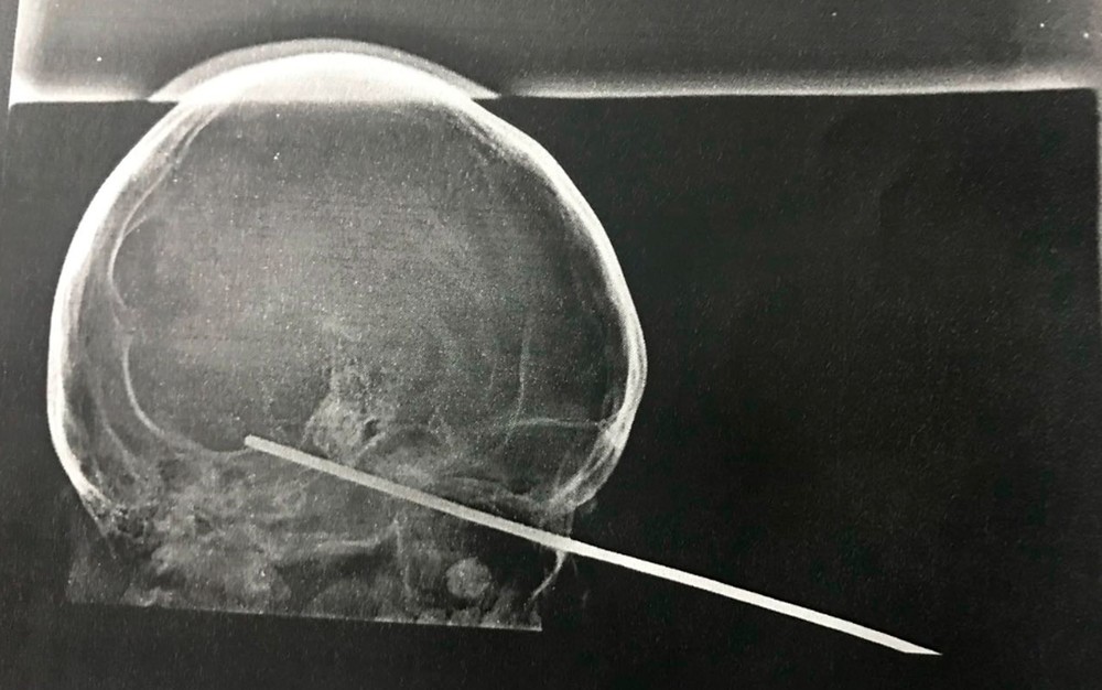 Menino tem espeto cravado no olho durante brincadeira com amigo