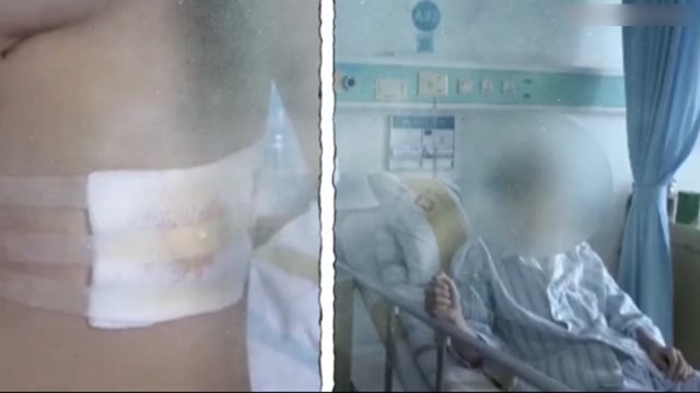 Bizarro! Homem sofre lesão no pulmão ao se espreguiçar pela manhã