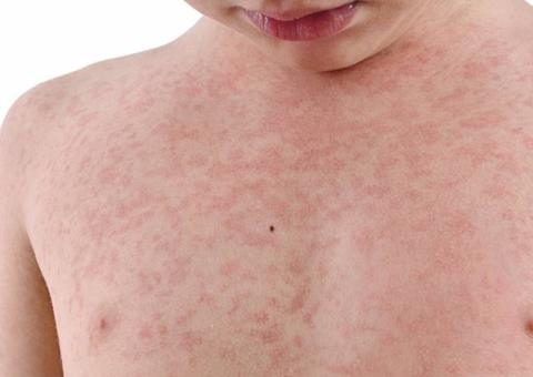 Manacapuru lidera número de casos notificados de sarampo