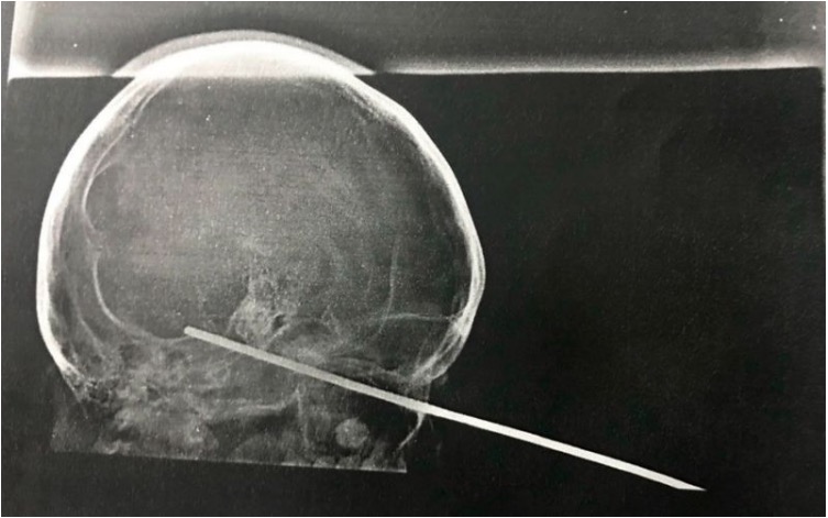 Menino de 8 anos que teve cérebro perfurado por espeto de churrasco deixa UTI