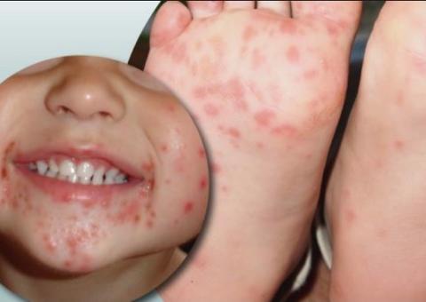 Síndrome mão-pé-boca é altamente contagiosa e atinge principalmente crianças.
