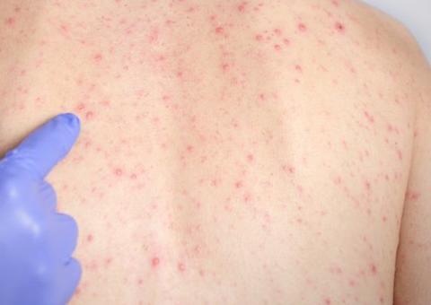 Novo levantamento da FVS confirma 180 casos de sarampo em Manacapuru