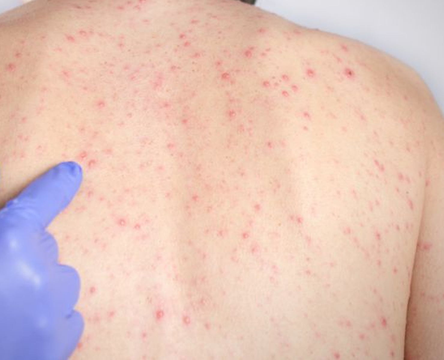 Novo levantamento da FVS confirma 180 casos de sarampo em Manacapuru