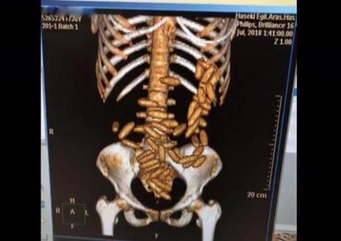 Brasileira é presa ao tentar desembarcar na Turquia com 50 cápsulas de drogas no estômago