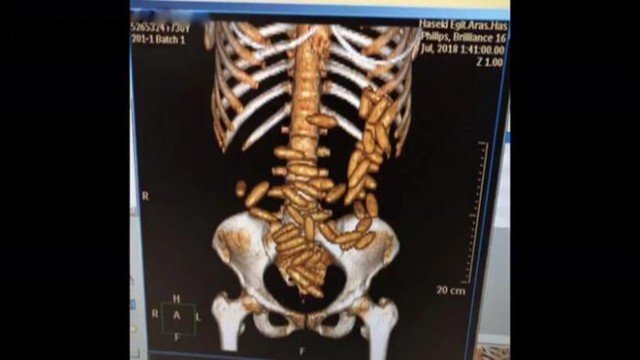 Brasileira é presa ao tentar desembarcar na Turquia com 50 cápsulas de drogas no estômago