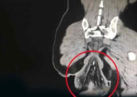 Homem tem reto movido para fora do corpo ao ficar no banheiro jogando no celular