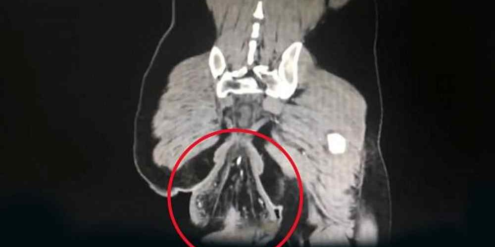 Homem tem reto movido para fora do corpo ao ficar no banheiro jogando no celular