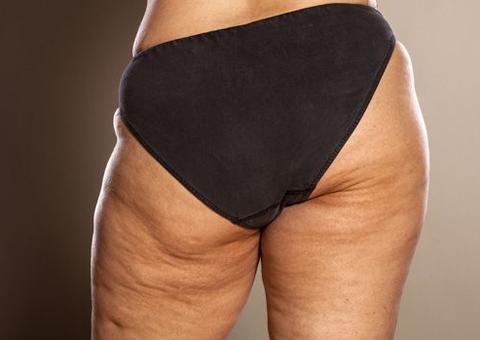Veja 5 alimentos e porque evitá-los se você quer acabar com a celulite