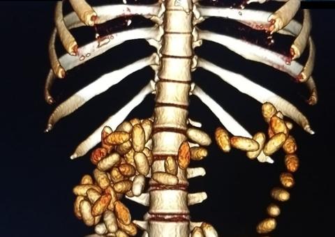 Homem é preso com 100 cápsulas de cocaína no estômago 