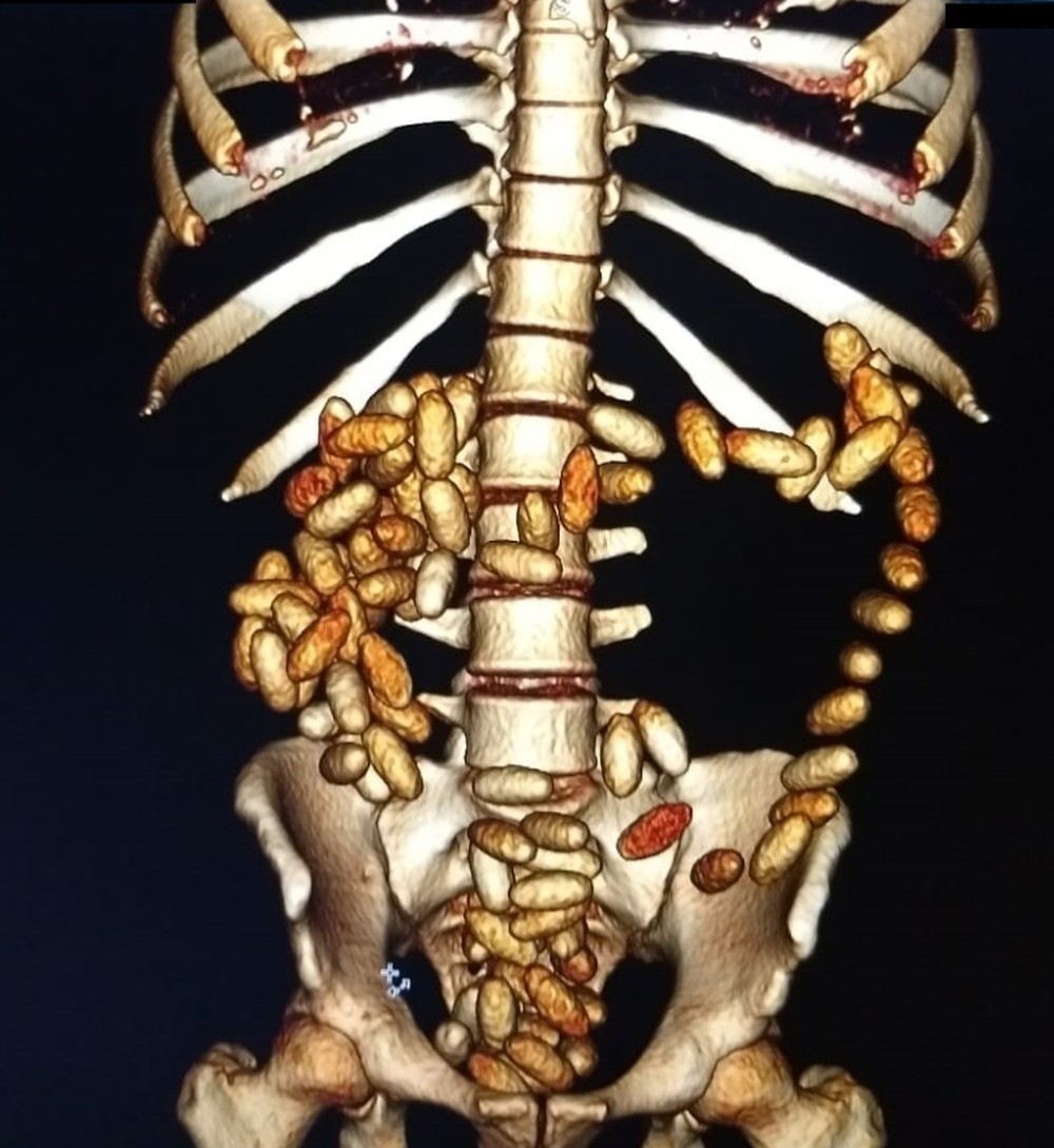 Homem é preso com 100 cápsulas de cocaína no estômago 