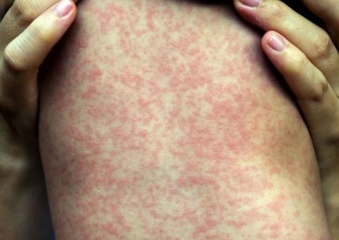 Brasil tem 1,1 mil casos confirmados de sarampo