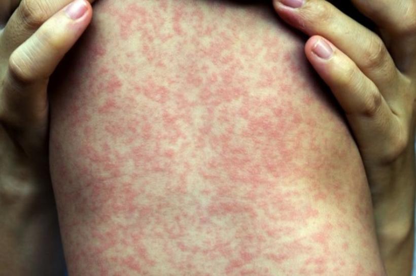 Brasil tem 1,1 mil casos confirmados de sarampo