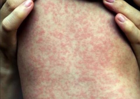  Bebê de 7 meses é o segundo a morrer vítima de Sarampo no Amazonas