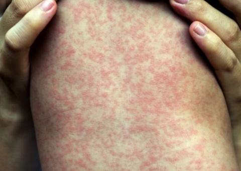 Bebê de 6 meses é o terceiro a morrer por sarampo no Amazonas