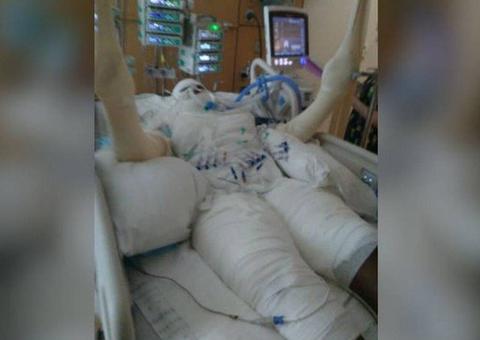 Menina de 12 anos tem 49% do corpo queimado após cumprir 'desafio do fogo'