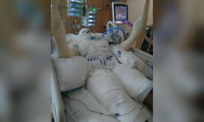 Menina de 12 anos tem 49% do corpo queimado após cumprir 'desafio do fogo'