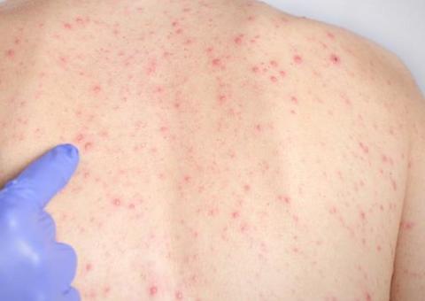 Novos casos de sarampo são confirmados no interior do Amazonas